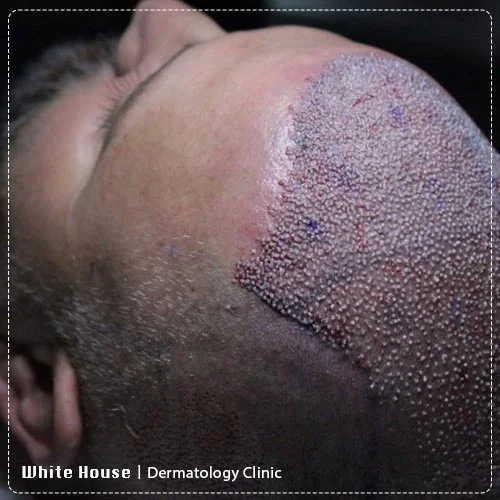 hair transplant0111