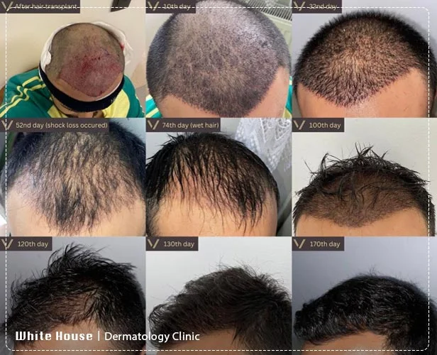 hair growth01