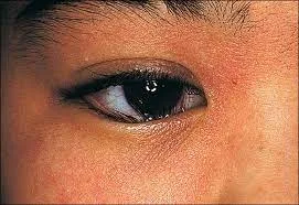 بیماری های خاص ابرو