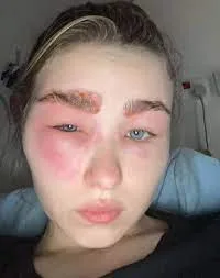 حساسیت به مواد در کاشت ابرو