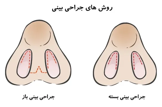 انواع روش جراحی بینی