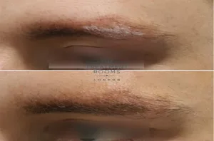 عفونت کاشت ابرو