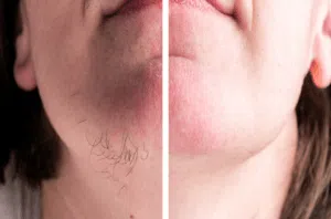 تاثیر لیزر مو بر روی هورمون ها و سلامت پوست